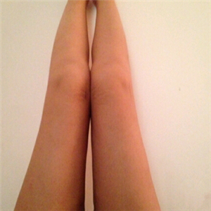 去找東方和諧馮斌做了大腿抽脂，分享一下果吧！